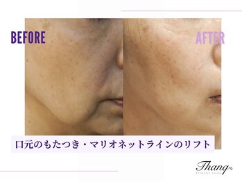 サンク(Thanq)/エラ張り・食いしばりさん用小顔