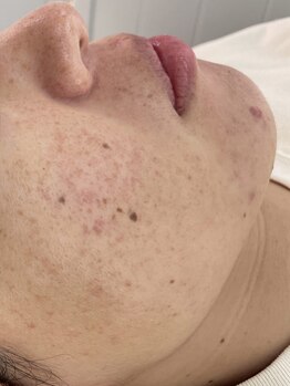 ベルファーム(Belle Femme)の写真/【様々なお肌のお悩みに◎初回3,500円～】一人一人に寄り添ったカウンセリングと施術でお悩みへアプローチ!