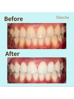 ホワイトニングサロン Blanche 心斎橋店/ビフォーアフター