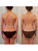 ミールーム(mi room)/痩身エステ３ヶ月半