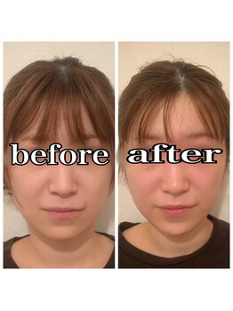 シェノン(CHAINON)/小顔矯正×石膏パック