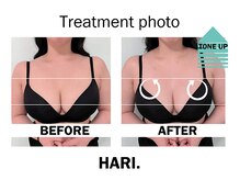 ハリドット 天王寺院(HARI.)/美乳鍼（垂れ、ハリ改善）20代