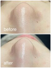 クゴ サロン(KUGO SALON)/高濃度水素ピーリング！