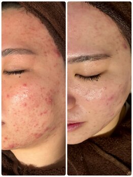 リラベル(Lira Belle)/お肌改善