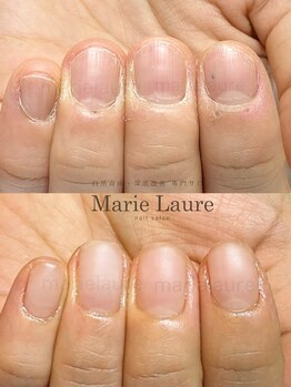 マリーロール 梅田店(Marie Laure)/深爪矯正/自爪育成/自爪風