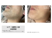 エクラ(eclat)/ヒゲ脱毛