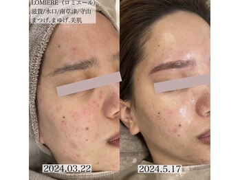 ロミエール 南草津店(LOMIERE)/ハーブピーリング¥9800