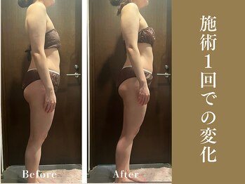 ザ モアナテラス(THE MOANA TERRACE)/施術1回の変化