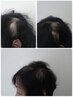頭皮ハーブピーリング【Level３】毛根から元気に!薄髪対策に◎￥30000