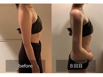 エイジングケアサロン 青山 本店/ブライダル★ビフォアアフター