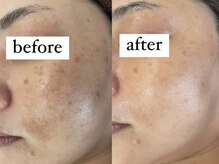 アワピール 成田公津の杜店(AWA PEELL)/ハーブピーリングでシミケア