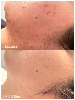 フルオール(FRUOR)/プラズマによるニキビ毛穴ケア