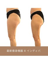 リム ビューティー(RYM BEAUTY)/最新超音波x インディバ 