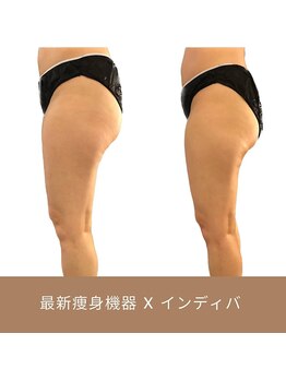 リム ビューティー(RYM BEAUTY)/最新超音波x インディバ