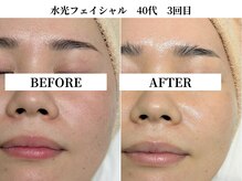 サンビ(SANBI)/冬の乾燥ケアは水光フェイシャル