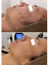 美時雨/ニキビにお悩みの方！