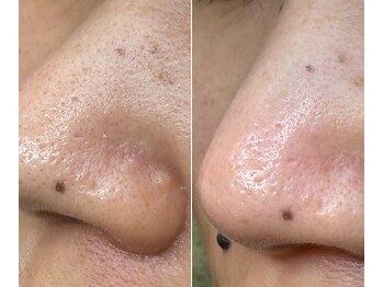 サイ(Sai)/before⇒after