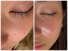 ヌナ(nuna)/小顔と美肌が叶う。毛穴洗浄