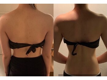 エイジングケアサロン 青山 本店/ブライダル★ビフォアアフター