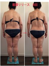 ビューティー サロン ハナ(Beauty Salon hana)/筋膜×痩身マシーン8回施術効果