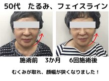 エンジェルエッグ/◆たるみが改善されたうれしい！