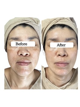 ル ボヌール 伊那店(le bonheur)/シミケア6回