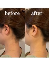 ミノア 大野城店(MINOA)/うなじ脱毛◆ビフォーアフター