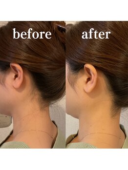 ミノア 大野城店(MINOA)/うなじ脱毛◆ビフォーアフター