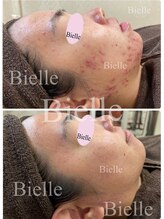 ビエル(Bielle)&nbsp;剥かない ニキビケア