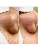 フワットン(Fouatons)/毛穴の開き、黒ずみが気になる方