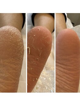 エターナル巻き爪金沢/