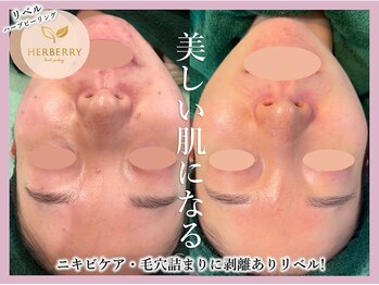 ハーバリー ハーブピーリング 大阪梅田店(HERBERRYハーブピーリング)/リベル・REVI・クリスティーナ