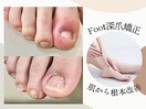 足の深爪矯正もお任せ下さい