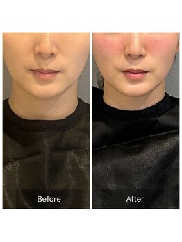 プライミー(PRIMY)/フェイスラインを整える