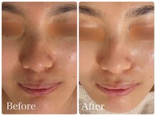 ロイヤル(ROYAL)/毛穴/ごわつき改善症例