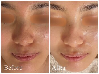 ロイヤル(ROYAL)/毛穴/ごわつき改善症例