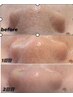 【毛穴の詰まり黒ずみ・毛穴の開き】角質ケア×肌質改善40分16000円→