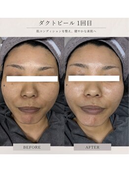 毛穴・肌質改善専門 private salon har’e【ハレ】　ピーリング/小顔の写真/【話題沸騰中☆次世代ピーリング】ダクトピールでついに本気の毛穴レスへ！繰り返す黒ずみ・開きを徹底ケア
