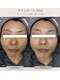 毛穴・肌質改善専門 private salon har’e【ハレ】　ピーリング/小顔の写真/【話題沸騰中☆次世代ピーリング】ダクトピールでついに本気の毛穴レスへ！繰り返す黒ずみ・開きを徹底ケア