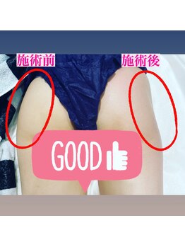 ルルン(LuLuN)/ヒップアップbefore、after