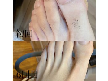 サロン ルーシュ(salon ruche)/脱毛(足の甲指)