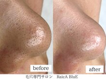 話題のエクストラクション!１回の施術で効果実感【毛穴ケア】