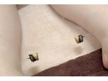 命水鍼灸院/冷え性【新宿/鍼灸】