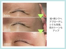 リラクゼーションアンドビューティーボヌール(BONHENR)/最新☆ラミネーションピーリング