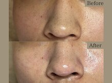 ティーツリー 名古屋 桜山(Tea Tree)/【毛穴ケア・毛穴洗浄】毛穴ケア