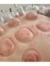 ビレイ(Birei)/カッサ＋カッピング