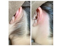 うなじ＆もみあげ＆首はブラジリアンワックスでスッキリします