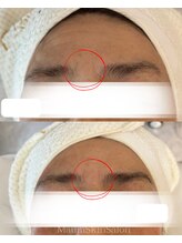 マウム(Maum)/眉間の深いシワにもアプローチ◎