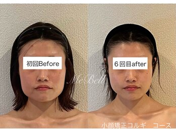 ミベル(MeBell)/小顔矯正/小顔コルギ