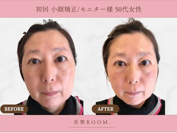 美整ルーム 横浜店(美整ROOM)/初回来店/モニター小顔矯正